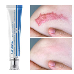 Advanced Scar Removal Cream - Effective Skin Repair for Surgical, Acne, and Stretch Marks