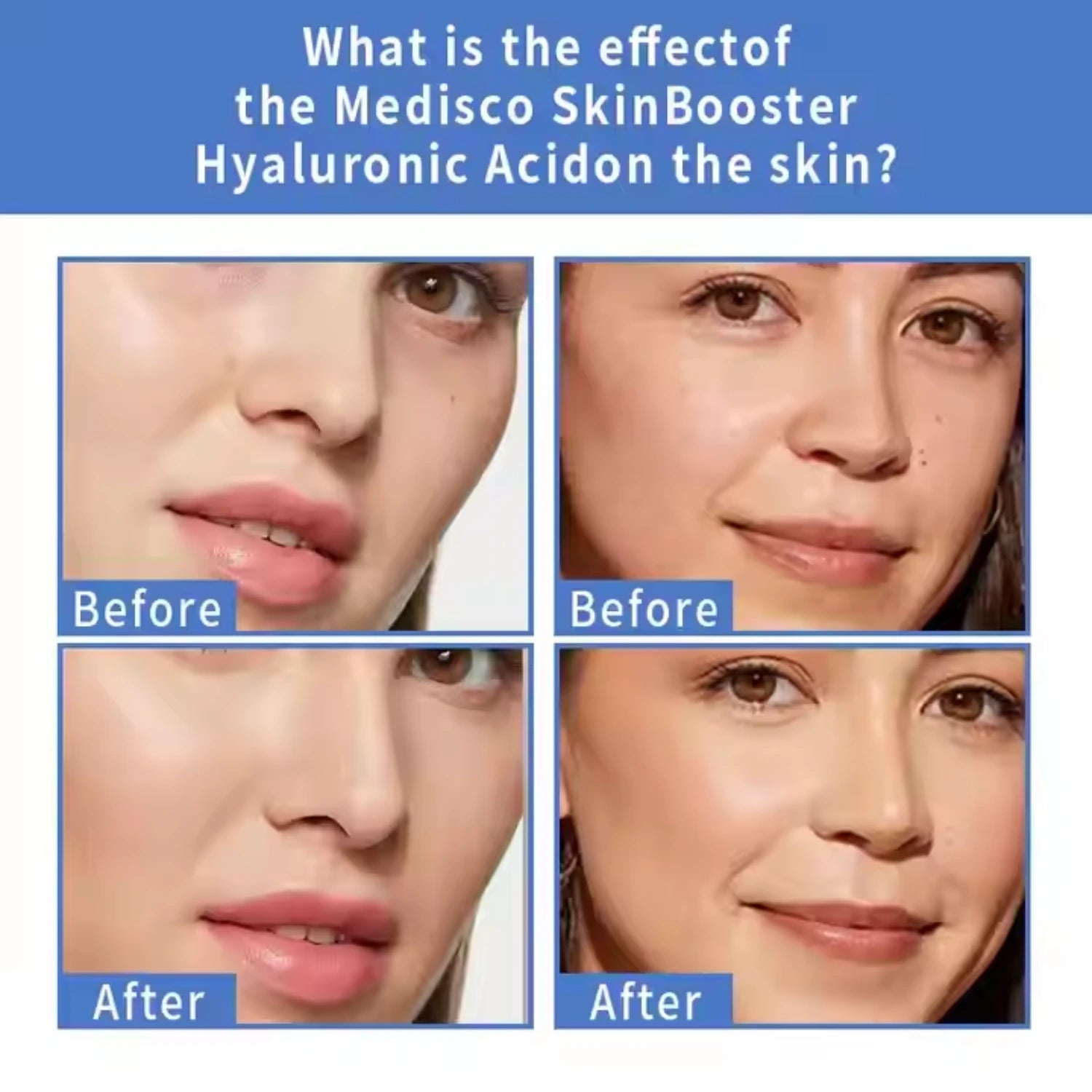 Advanced Skin Booster Hyaluronic Acid Serum - Anti-Aging & Hydration Treatment with Niacinamide, Retinol, Amino Acids, and Vitamins for Youthful Glow - 10 Vials
