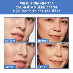 Advanced Skin Booster Hyaluronic Acid Serum - Anti-Aging & Hydration Treatment with Niacinamide, Retinol, Amino Acids, and Vitamins for Youthful Glow - 10 Vials