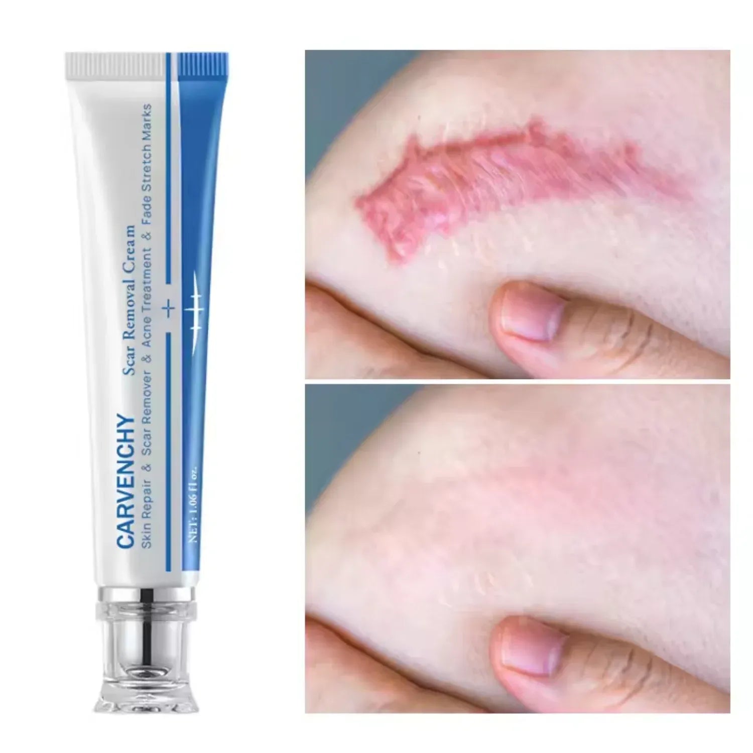 Advanced Scar Removal Cream - Effective Skin Repair for Surgical, Acne, and Stretch Marks