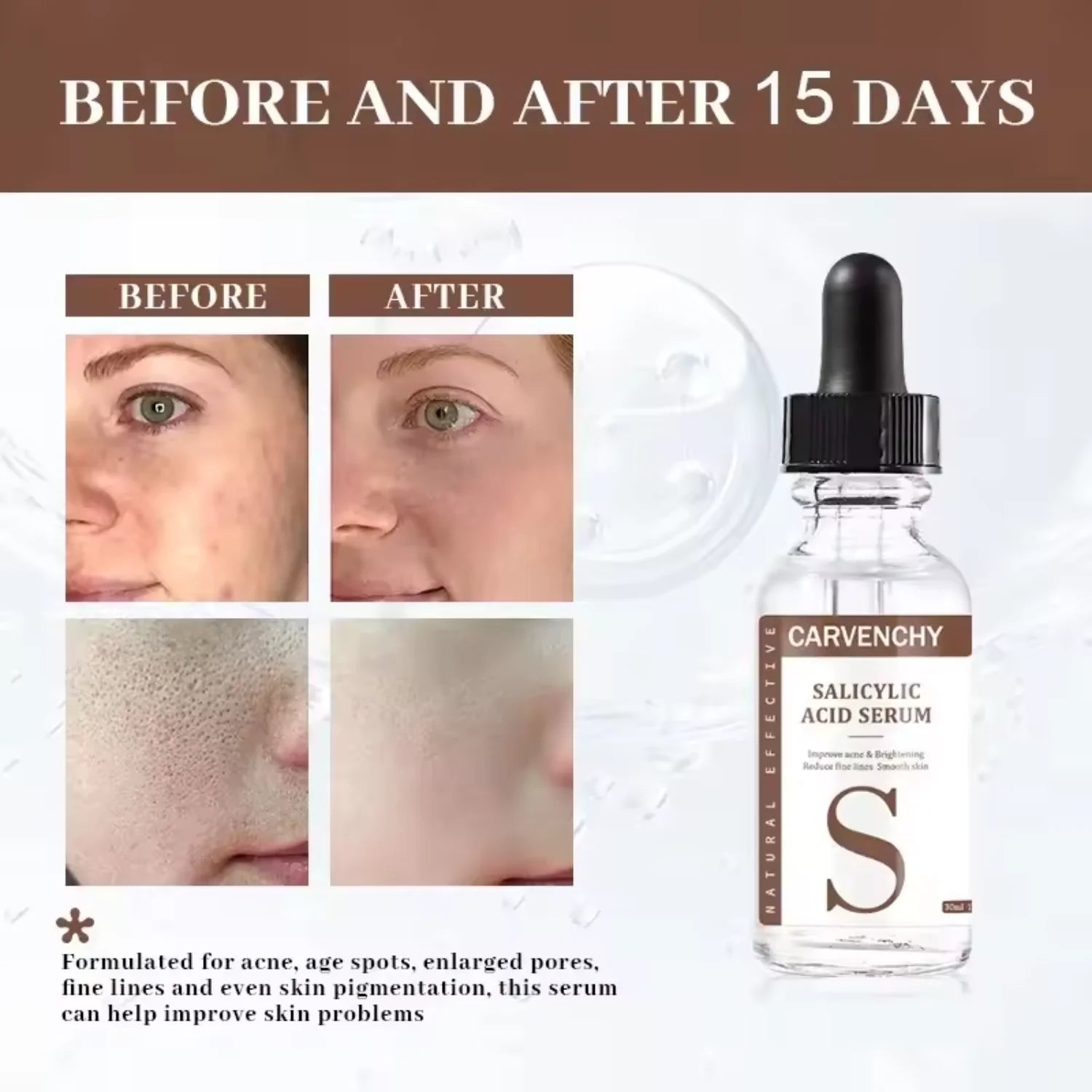 Salicylic Acid Serum for Clear Skin - Natural Acne Treatment with Glycolic, 30ml