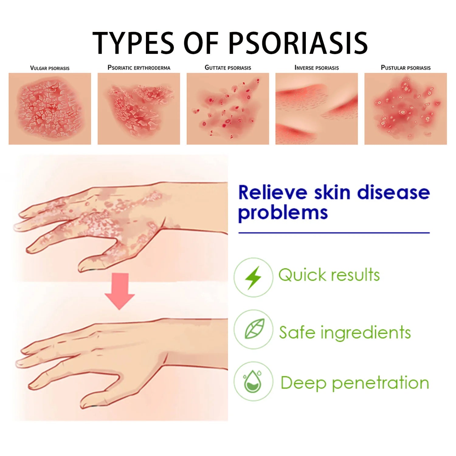 Britains Beauty Herbal Extract Psoriasis Ointment - Relieve Psoriasis, Itching & Fungal Infection - Safe, Non-Toxic, Deep Penetration