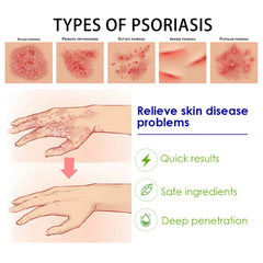 Britains Beauty Herbal Extract Psoriasis Ointment - Relieve Psoriasis, Itching & Fungal Infection - Safe, Non-Toxic, Deep Penetration